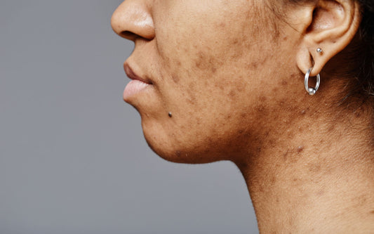 Pigmentflecken entfernen – Ursachen, Methoden und Skincare-Tipps