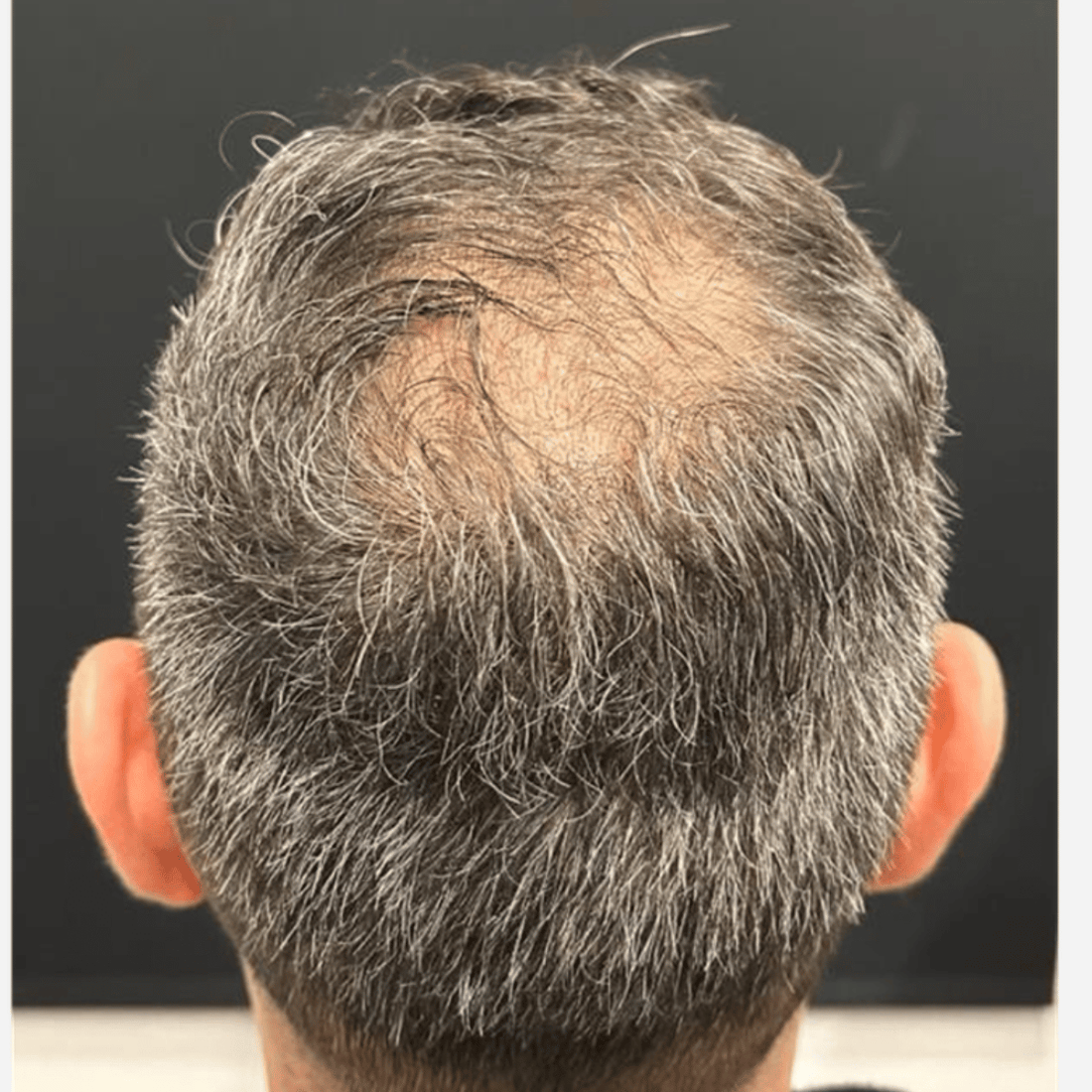 vorher Exosome Haare