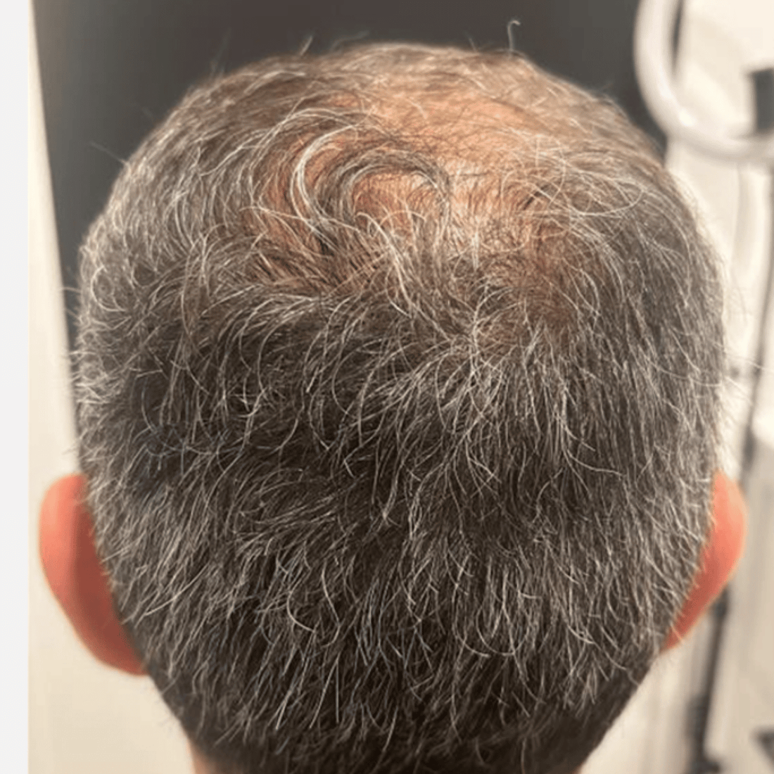 nachher exosome Haare
