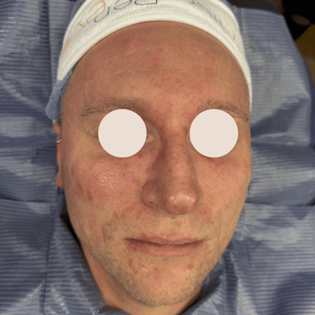 Rosacea Exosome vorher